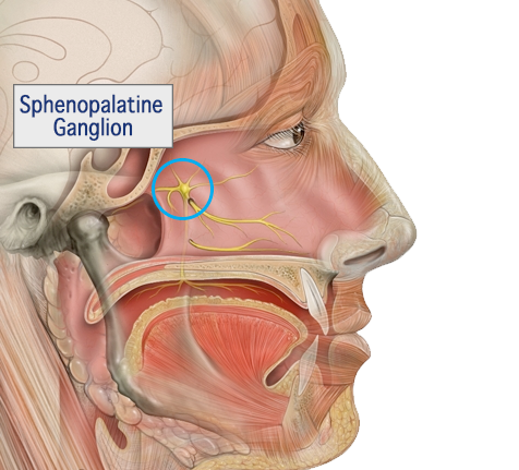 Sphenopalatine Ganglion Nerve Block for Migraine & Headache Relief